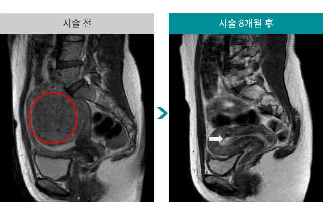민트병원_자궁근종 색전술1.png