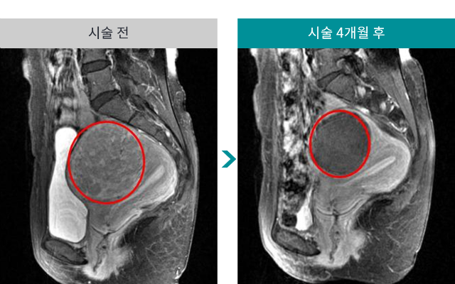 민트병원_자궁근종 색전술2.png