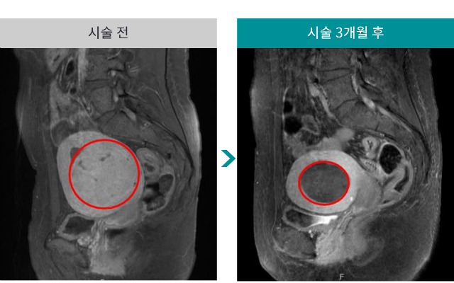 민트병원_자궁근종 색전술6.png