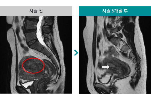 민트병원_자궁근종 색전술7.png