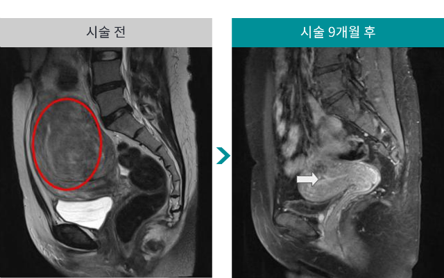 민트병원_자궁근종 색전술10.png