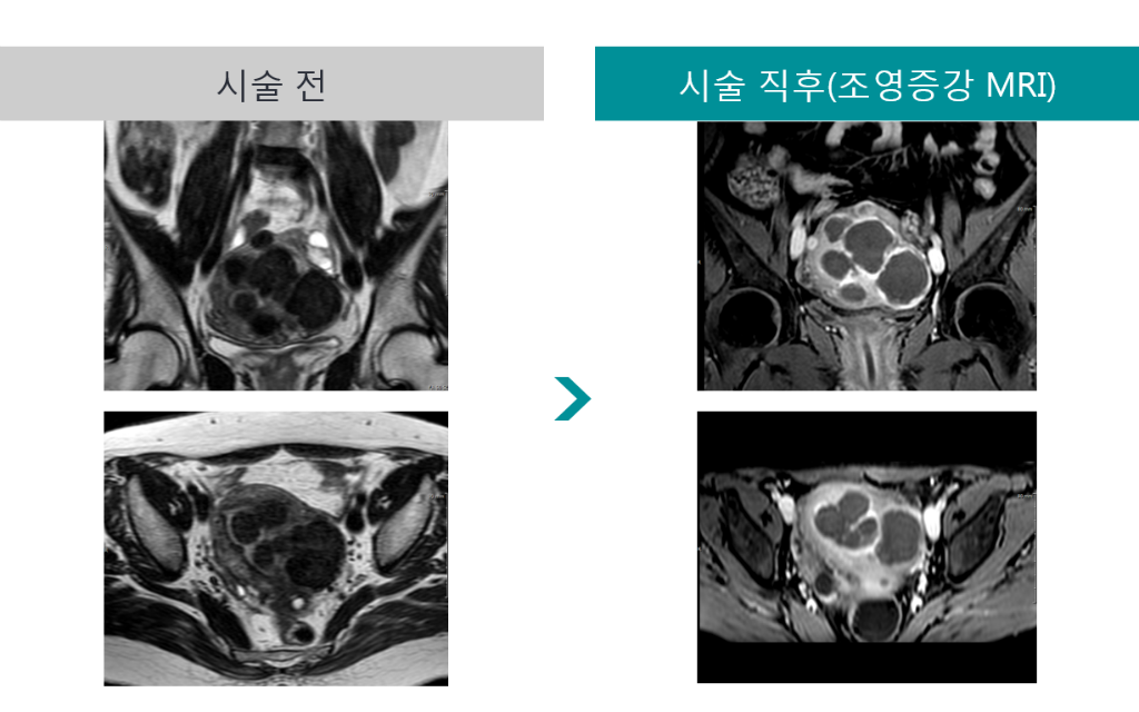 민트병원_MR하이푸3_43세 생리과다 생리통.png