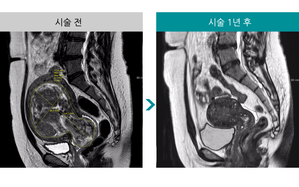 민트병원_자궁근종색전술시술전후.jpg