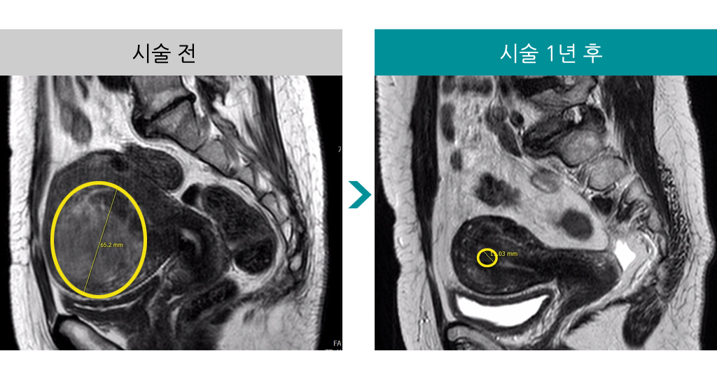 시술1년.jpg