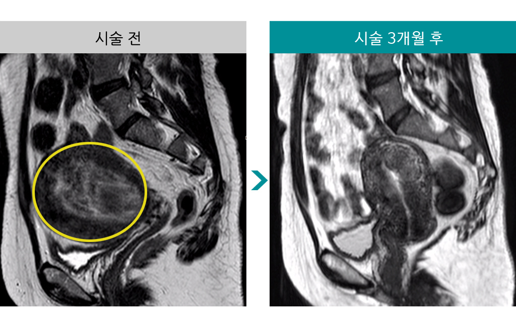 48세_색전술자궁경.jpg