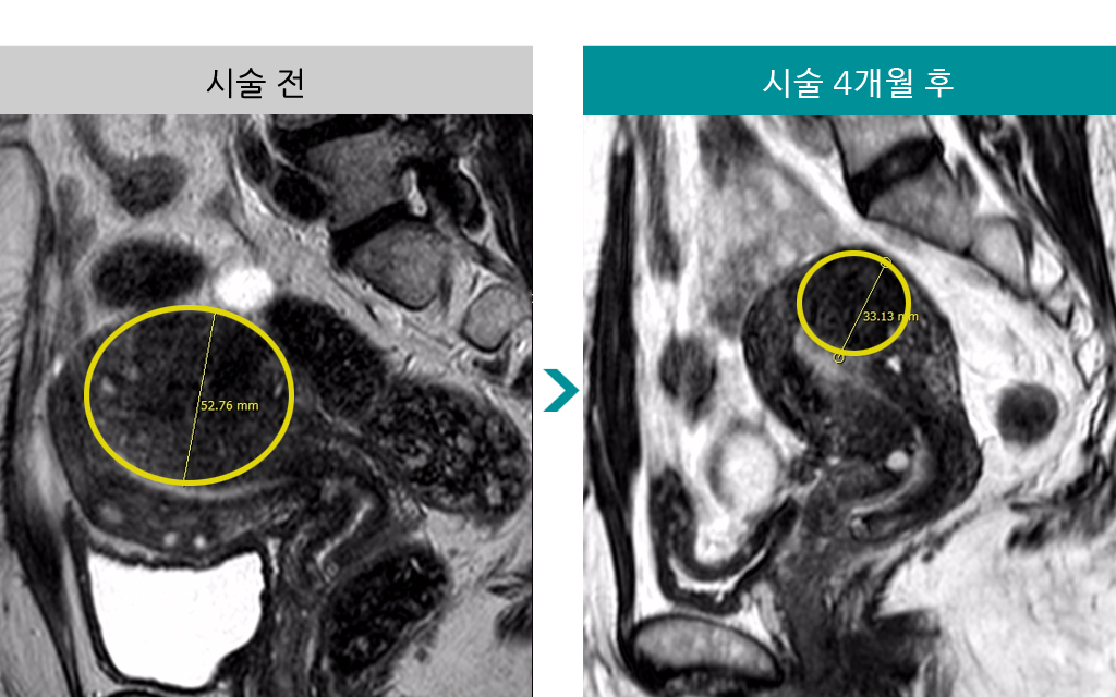 45세색전술.jpg