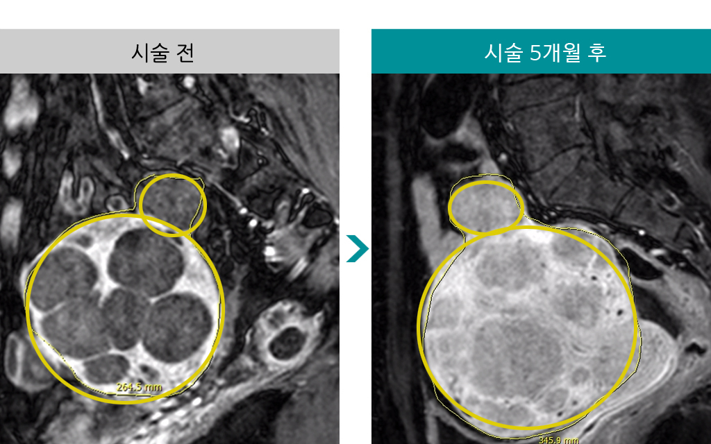 46세_색전술_다발성.jpg