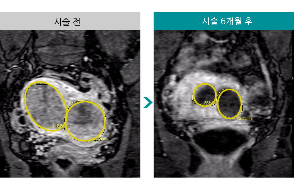 40세_색전술_6개월.jpg