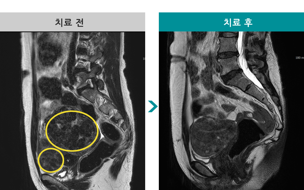 47세근종절제수술.jpg