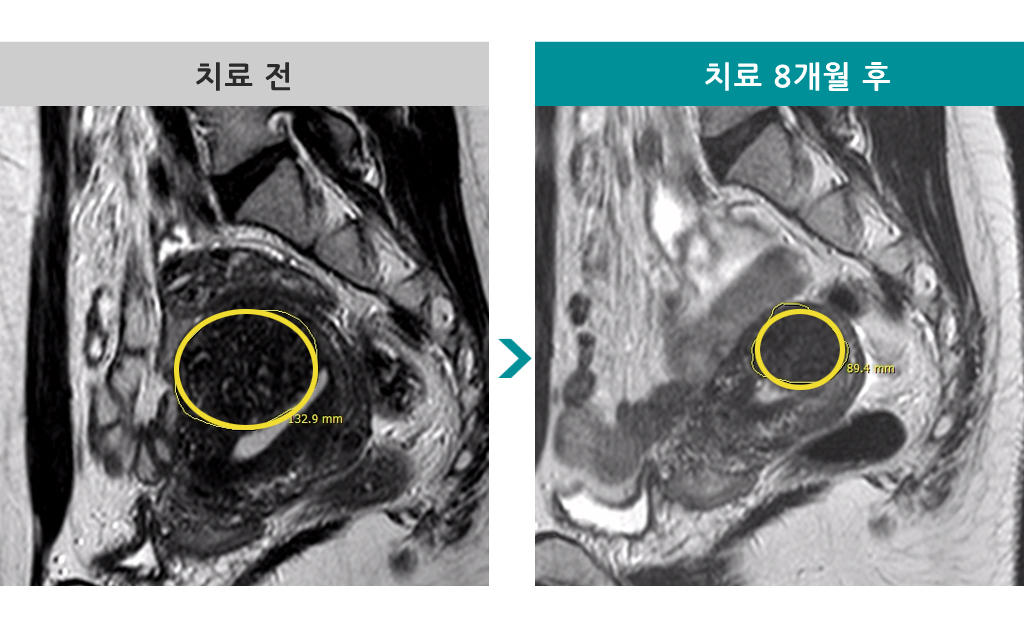 35세선근증.jpg