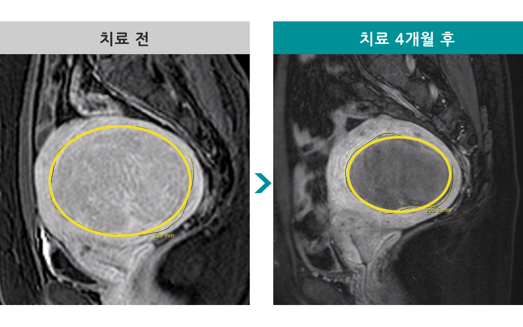 36세근종색전술.jpg