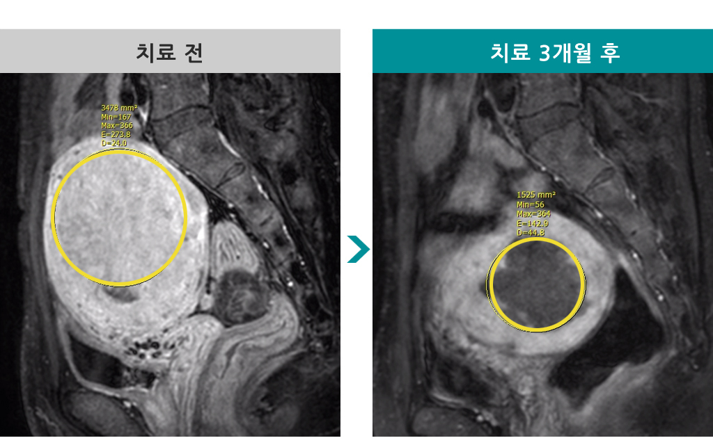 41세미만성선근증.jpg