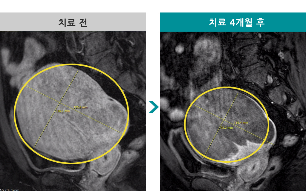 46미만성선근증.jpg