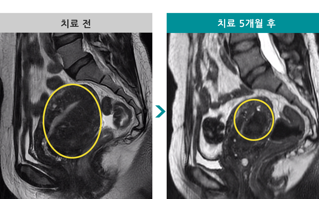 45세미만성선근증.jpg