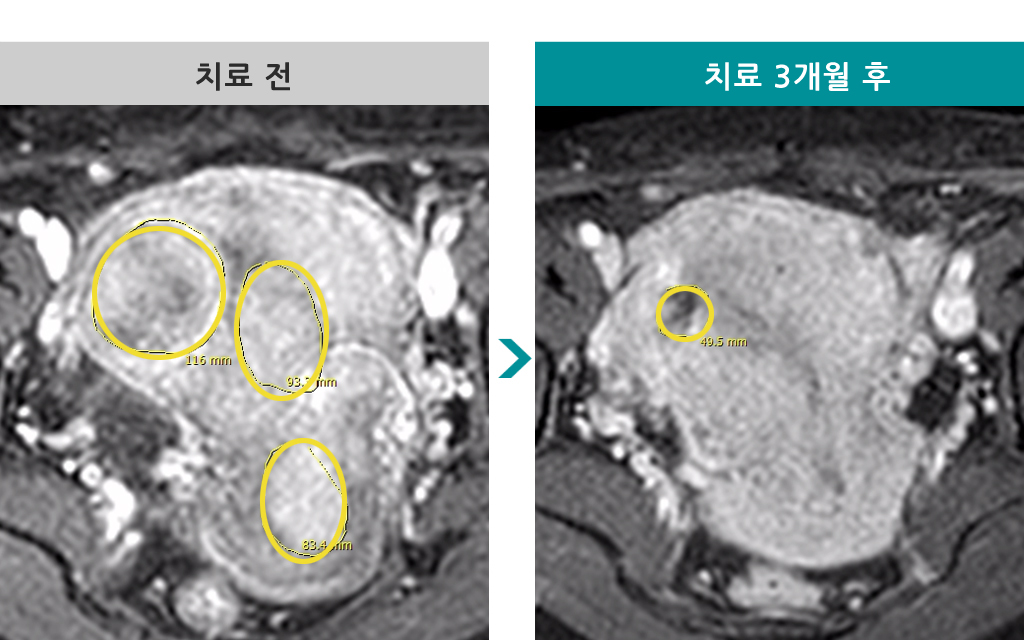 50세엠알하이푸.jpg