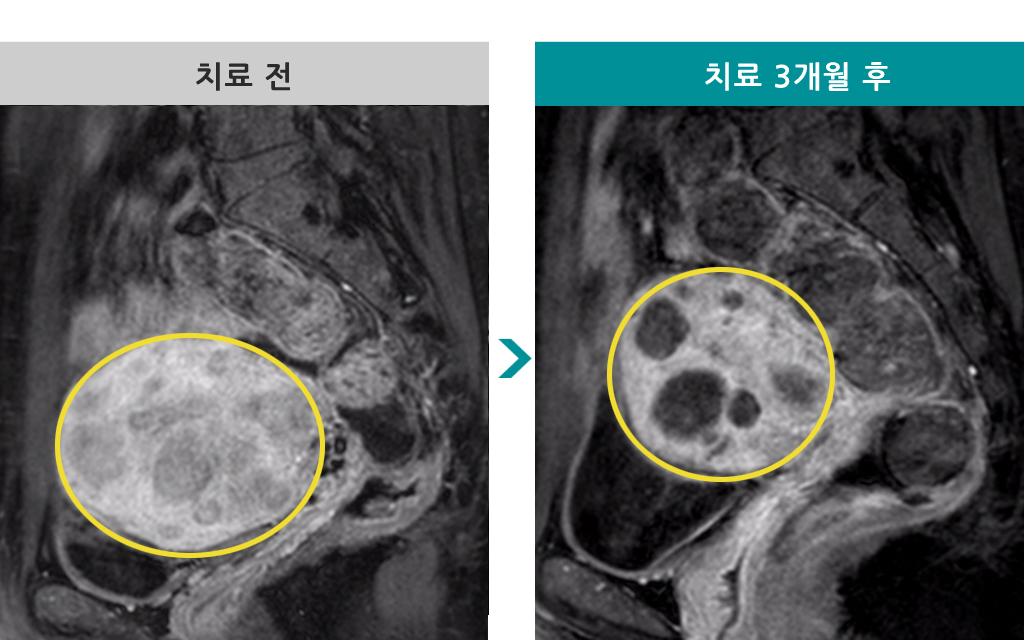 44세색전술다발성.jpg