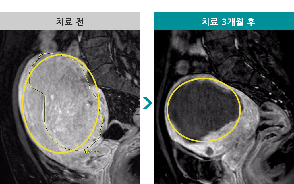 44미만선근증.jpg