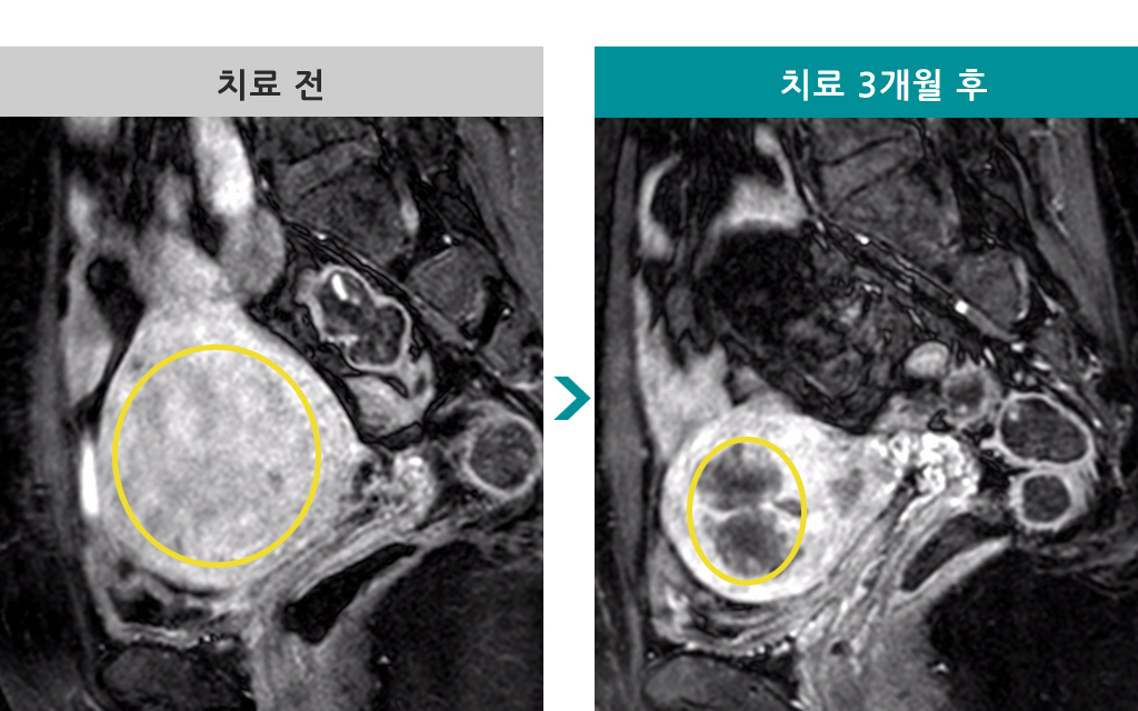 48세미만선선근증근종색전술.jpg