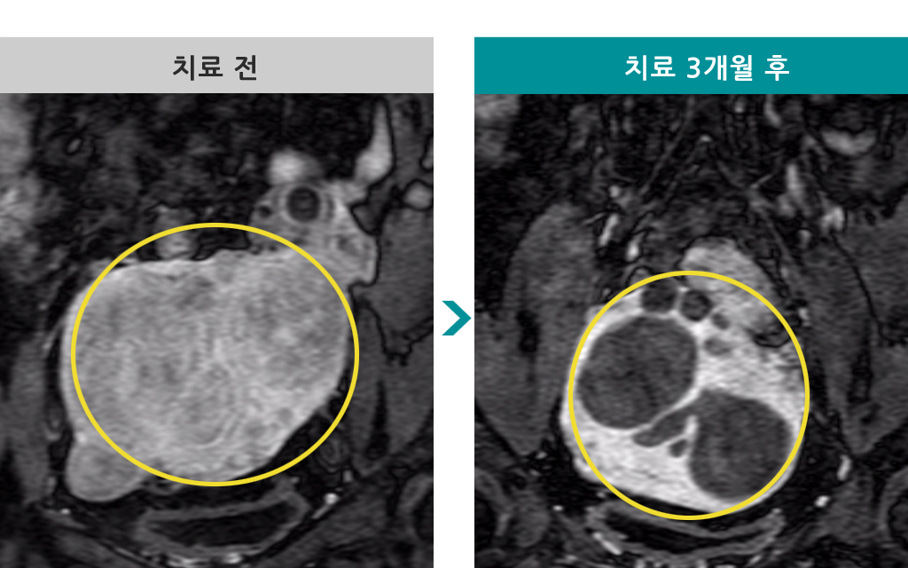 40세다발성색전술.jpg