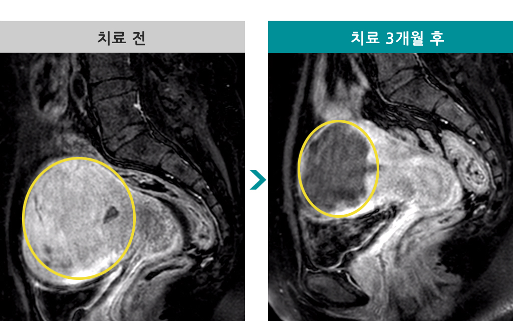 45세미만선근증색전술.jpg