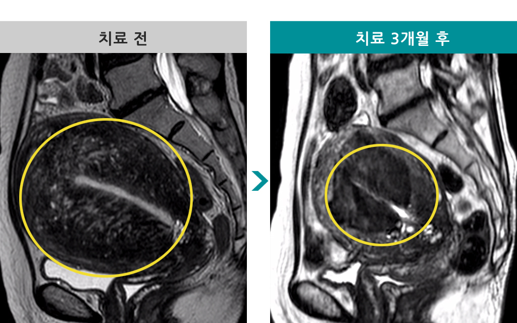 53세미만성선근증색전.jpg