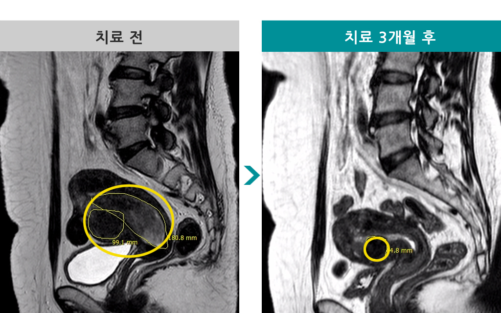 42세점막하근종색전술.jpg