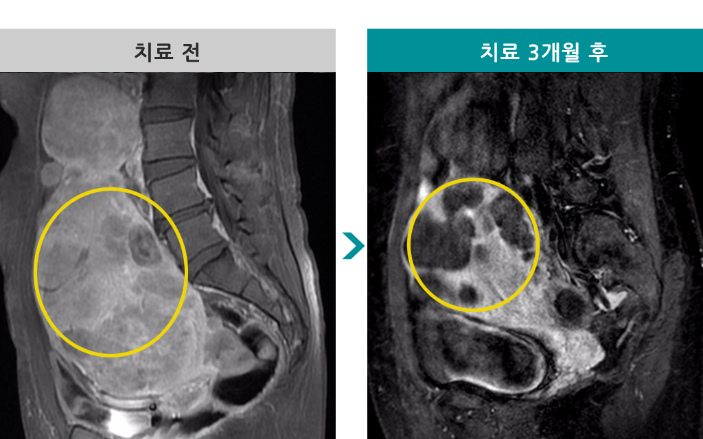 43세다발성거대색전술.jpg