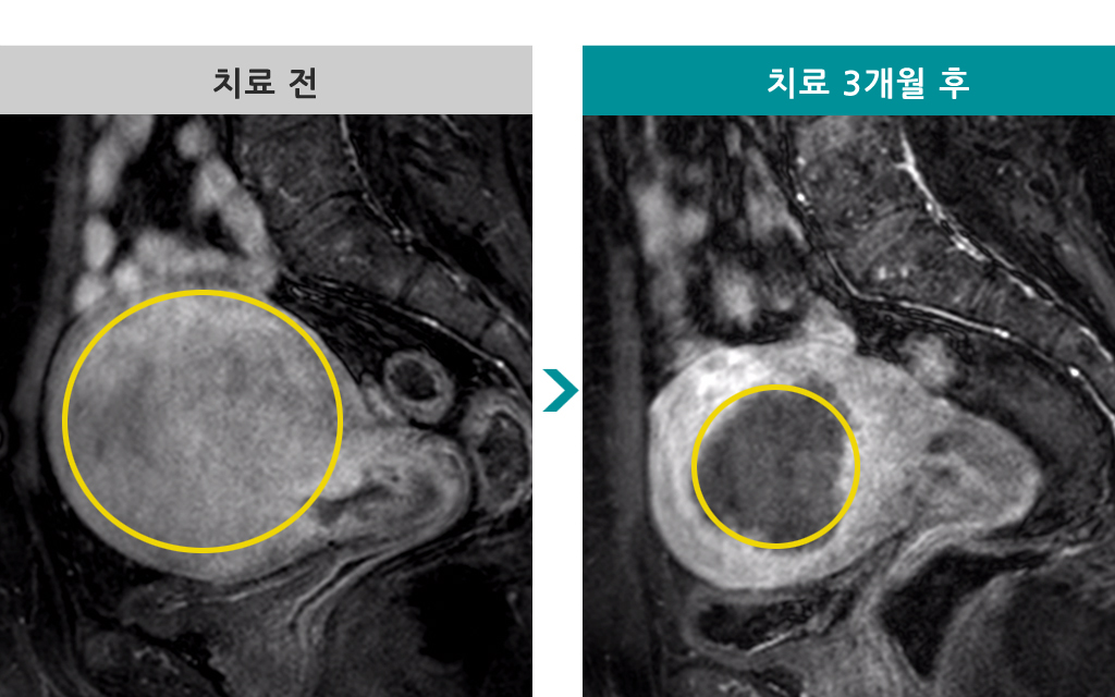 43세선근증.jpg