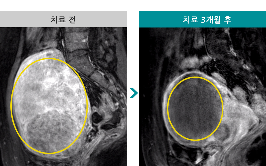 35세셀수없는근종.jpg