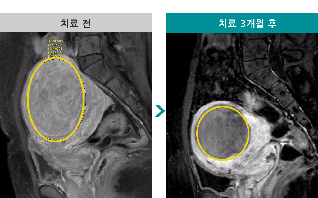 50세자라는거대근종.jpg