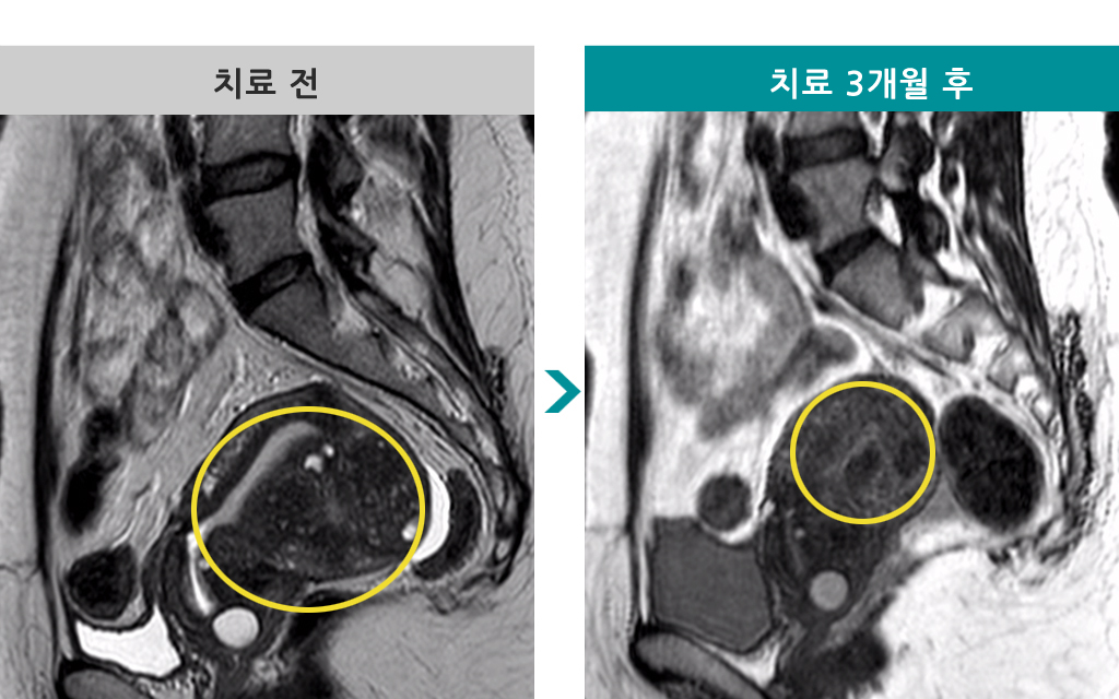 39세선근증색전술.jpg