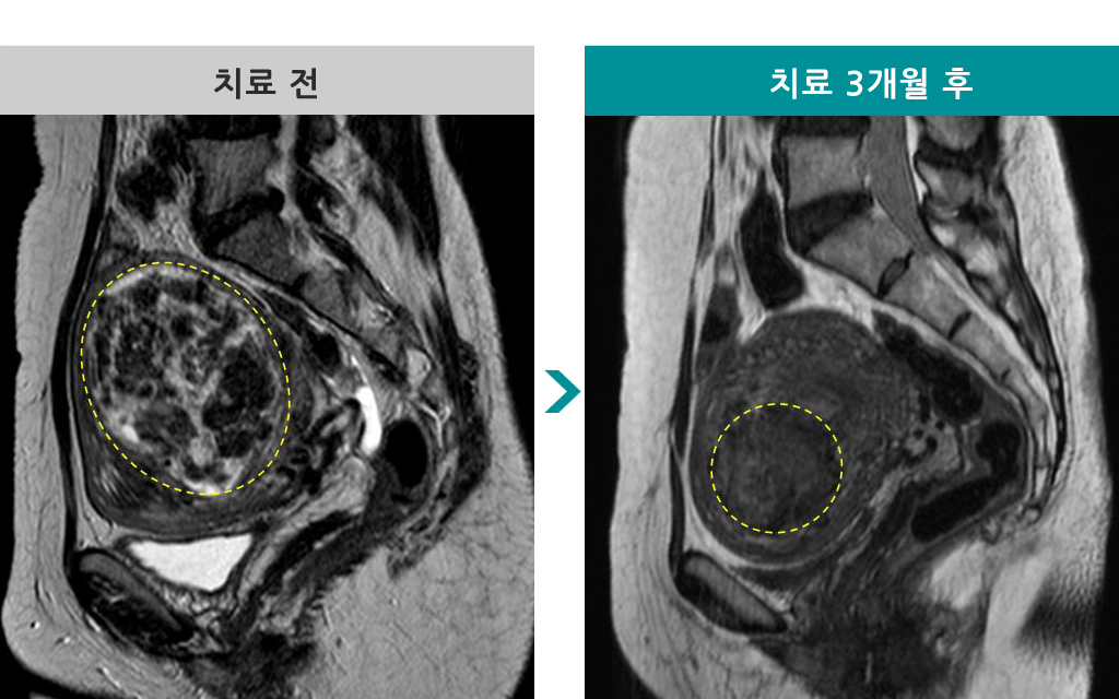 47세엠알하이푸.jpg