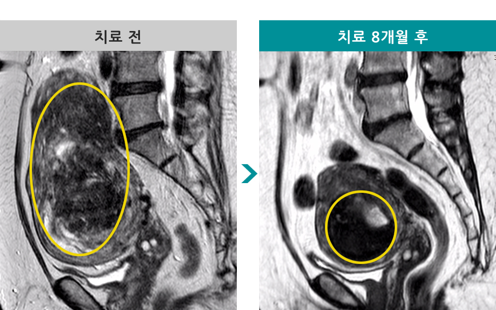 52세근종선근증.jpg