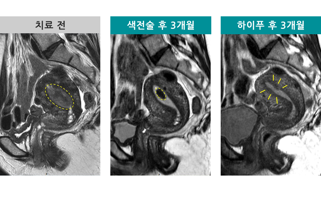 색전술하이푸하이브리드.jpg