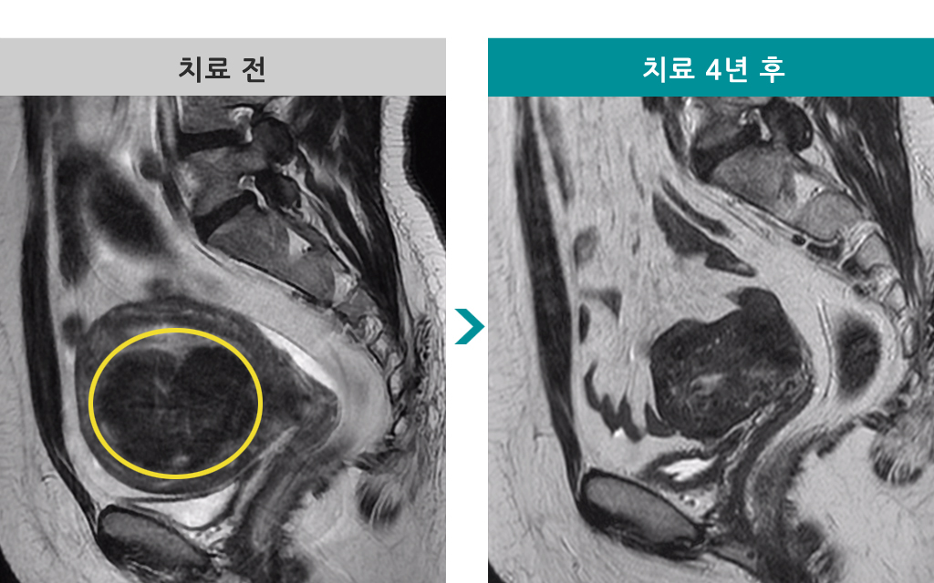 47세근종색전술.jpg