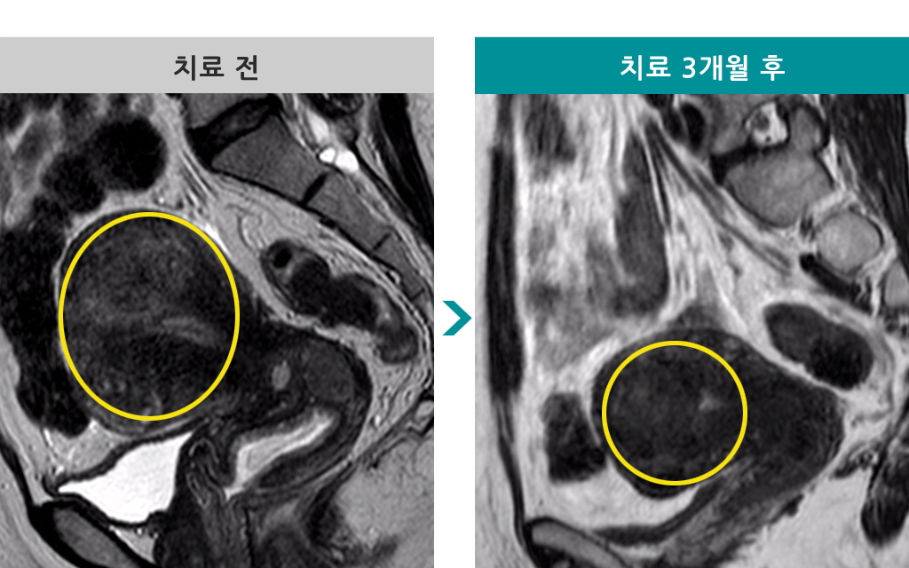 47세미만성선근증.jpg