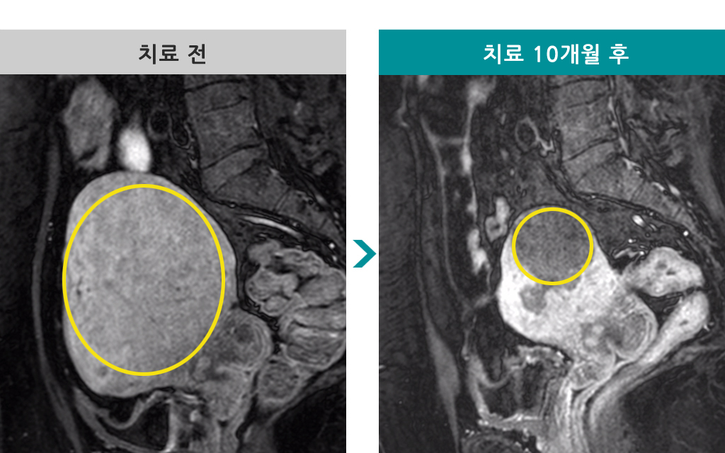 44선근증.jpg