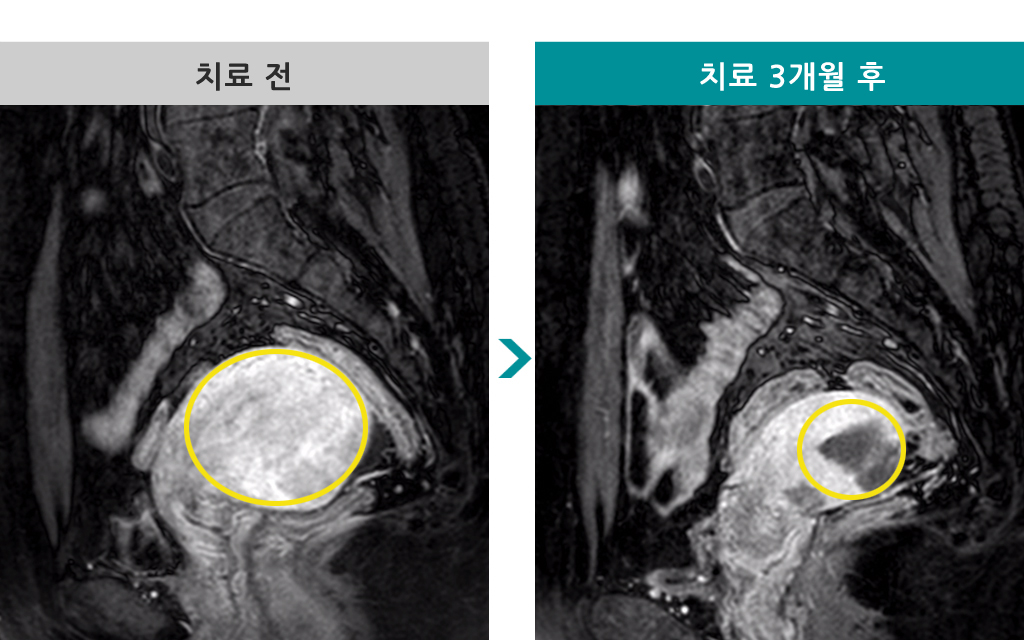 43세선근증색전술.jpg