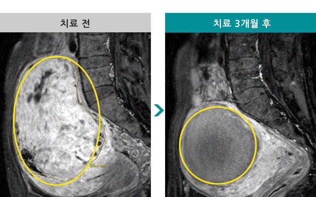 43세00839838색전술.jpg