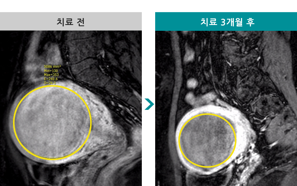 00839222색전술.jpg