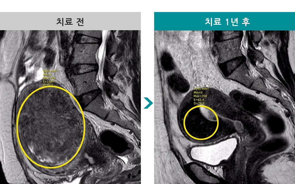 42세00819670색전술.jpg