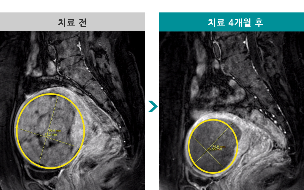 38세00839940색전술.jpg