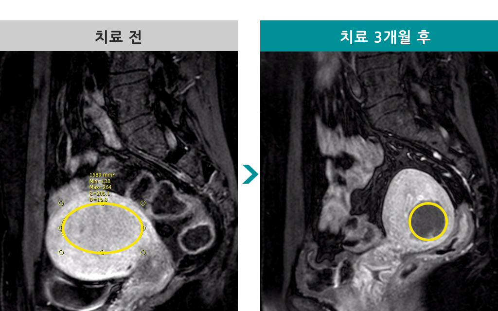 00841966선근증색전술45세.jpg