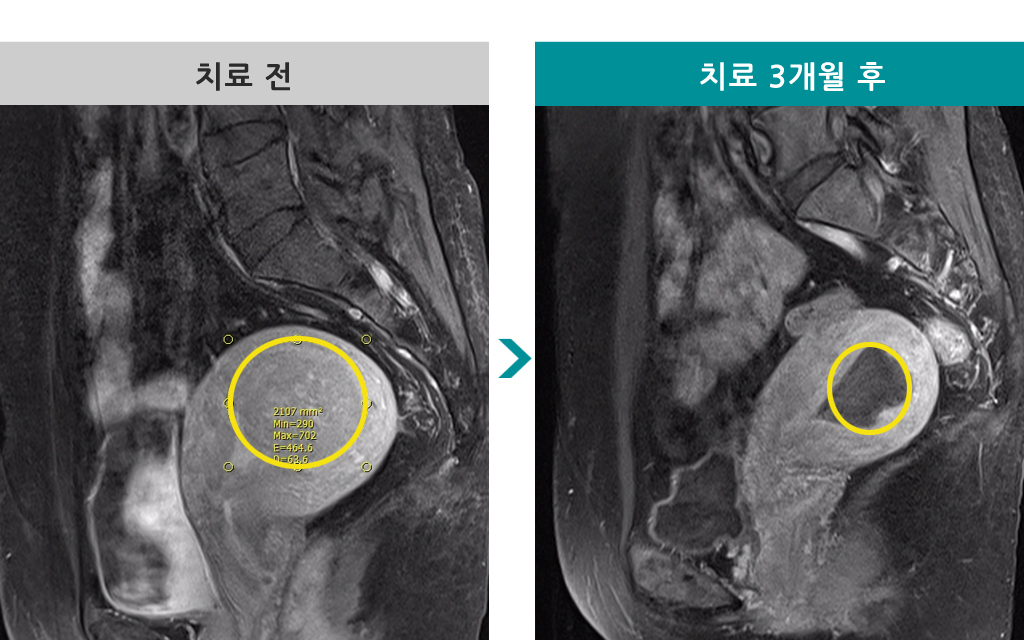 00806421색전술47세.jpg