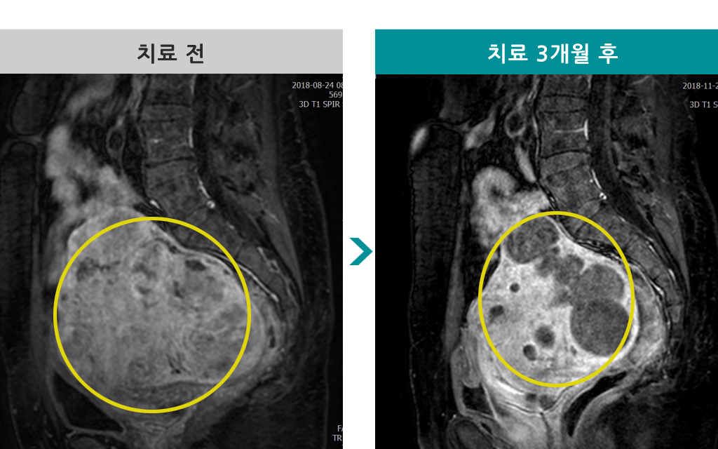 48세다발성거대00842280.jpg