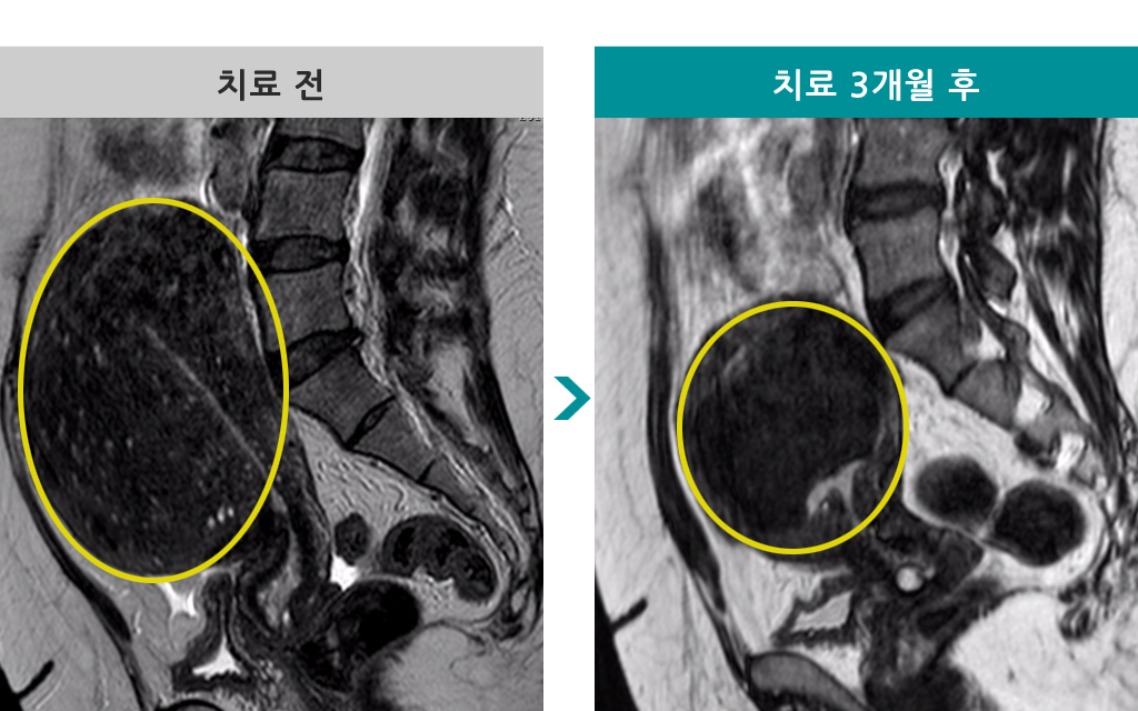 선근증00841000색전술.jpg