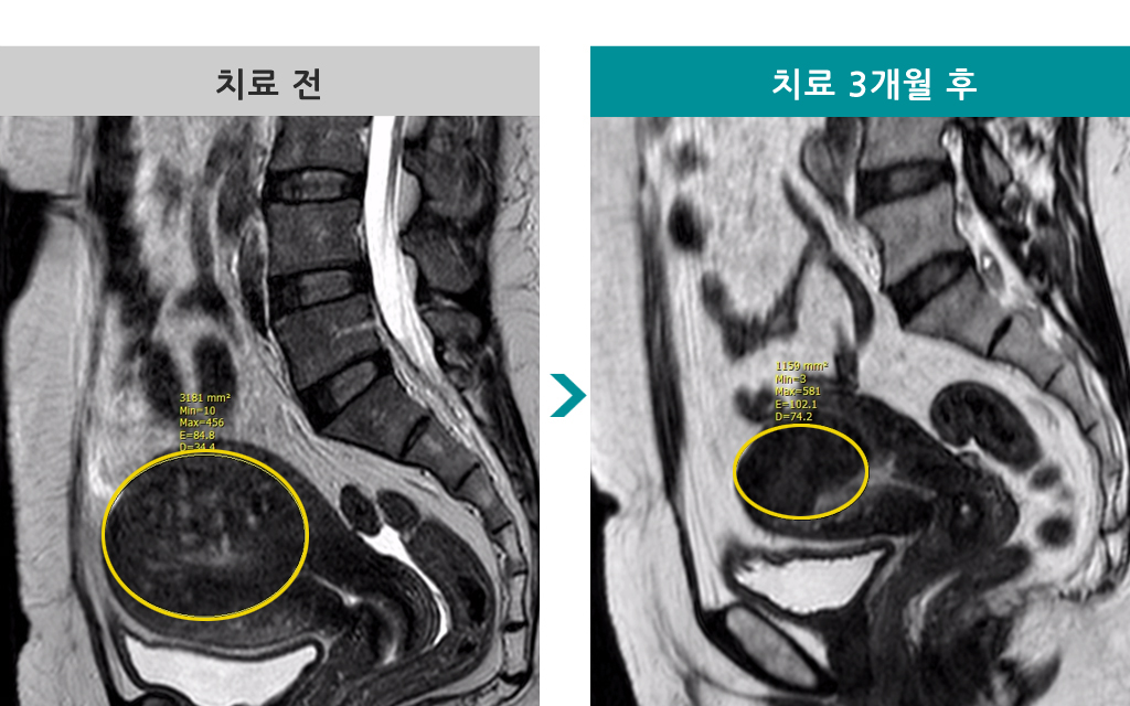 44세00843662선근증색전술.jpg