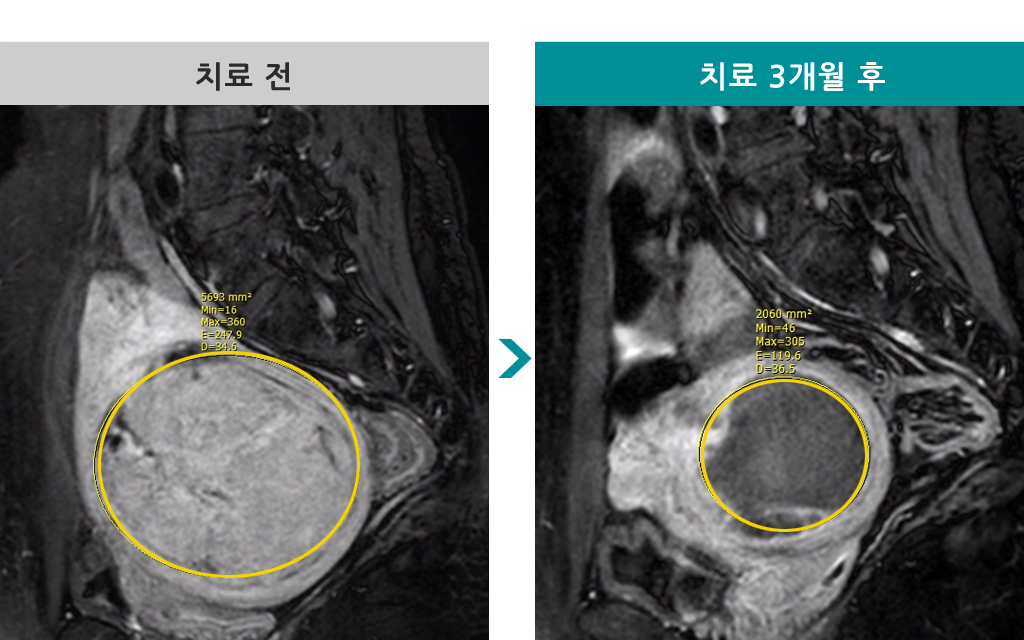 47세00842046근종색전술.jpg