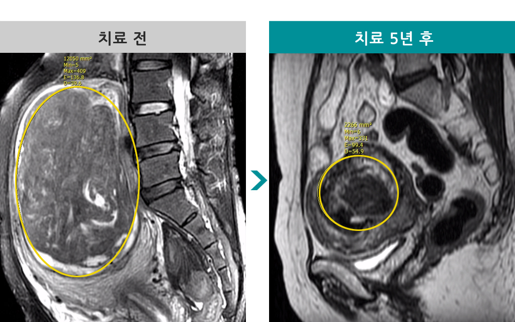 49세00809175거대근종색전술.jpg