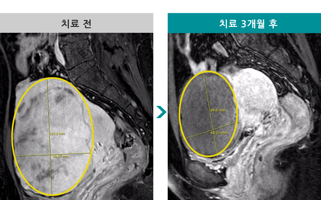 37세00843499거대근종색전술.jpg